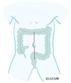 Opération intestinale avec incision abdominale