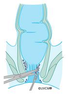 Elimination conventionelle des hémorroïdes