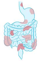 Inflammation Morbus Crohn