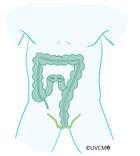 Après la Résection du rectum