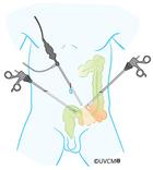 Opération laparoscopic diverticulite