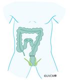 Après la résection du colon gauche