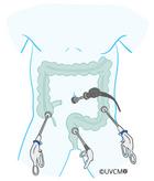 Opération intestinale laparascopique