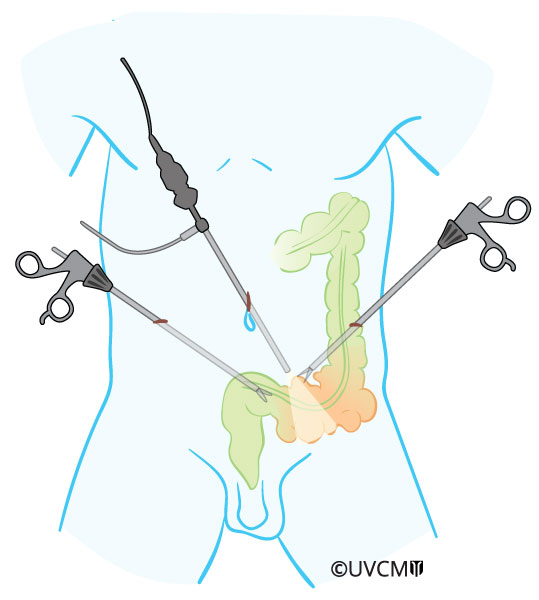 La maladie diverticulaire | Darmzentrum Bern